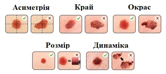 Меланома: фактори ризику та профілактика детская больница запорожье КНП «Міська дитяча лікарня №5» ЗМР – це єдина у місті Запоріжжі багатопрофільна дитяча лікарня, де сконцентровано всі види надання спеціалізованої медичної допомоги дитячому населенню: стаціонарної, консультативної амбулаторно-поліклінічної та виїзної для інтенсивної терапії новонародженим.