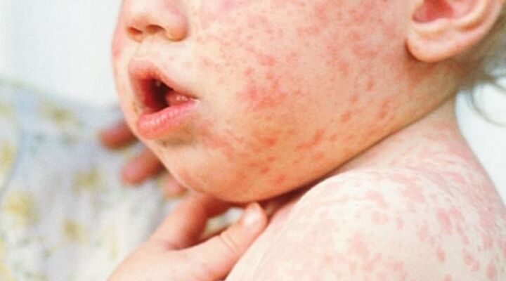 Як розпізнати кір детская больница запорожье КНП «Міська дитяча лікарня №5» ЗМР – це єдина у місті Запоріжжі багатопрофільна дитяча лікарня, де сконцентровано всі види надання спеціалізованої медичної допомоги дитячому населенню: стаціонарної, консультативної амбулаторно-поліклінічної та виїзної для інтенсивної терапії новонародженим.