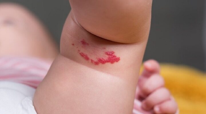 Дитяча гемангіома детская больница запорожье КНП «Міська дитяча лікарня №5» ЗМР – це єдина у місті Запоріжжі багатопрофільна дитяча лікарня, де сконцентровано всі види надання спеціалізованої медичної допомоги дитячому населенню: стаціонарної, консультативної амбулаторно-поліклінічної та виїзної для інтенсивної терапії новонародженим.