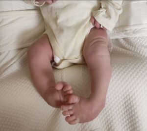 Вроджена деформація стоп - не вирок детская больница запорожье КНП «Міська дитяча лікарня №5» ЗМР – це єдина у місті Запоріжжі багатопрофільна дитяча лікарня, де сконцентровано всі види надання спеціалізованої медичної допомоги дитячому населенню: стаціонарної, консультативної амбулаторно-поліклінічної та виїзної для інтенсивної терапії новонародженим.