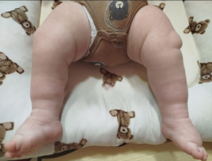 Вроджена деформація стоп - не вирок детская больница запорожье КНП «Міська дитяча лікарня №5» ЗМР – це єдина у місті Запоріжжі багатопрофільна дитяча лікарня, де сконцентровано всі види надання спеціалізованої медичної допомоги дитячому населенню: стаціонарної, консультативної амбулаторно-поліклінічної та виїзної для інтенсивної терапії новонародженим.