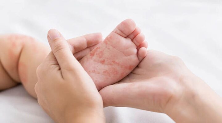 Краснуха у дітей: коли потрібно робити щеплення? детская больница запорожье КНП «Міська дитяча лікарня №5» ЗМР – це єдина у місті Запоріжжі багатопрофільна дитяча лікарня, де сконцентровано всі види надання спеціалізованої медичної допомоги дитячому населенню: стаціонарної, консультативної амбулаторно-поліклінічної та виїзної для інтенсивної терапії новонародженим.